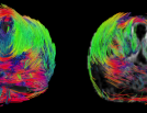 DTI fibre tracking MRI in an ex-vivo human prostate