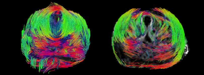 DTI fibre tracking MRI in an ex-vivo human prostate