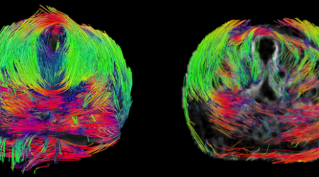 DTI fibre tracking MRI in an ex-vivo human prostate